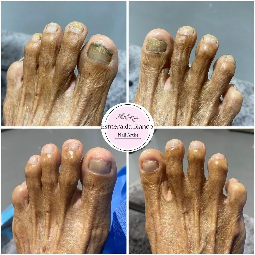 Tratamiento clínico para uñas encarnadas