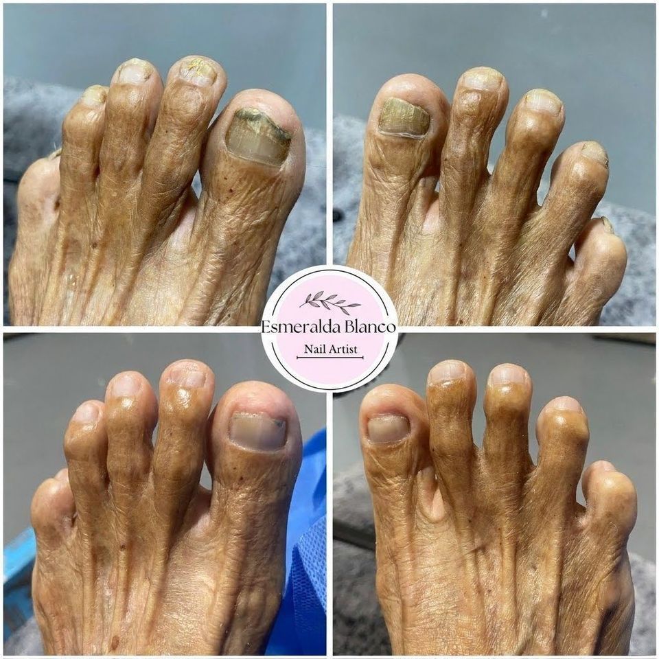 Tratamiento clínico para uñas encarnadas