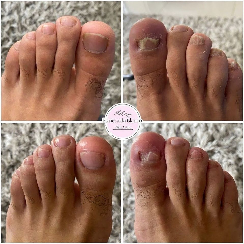 Cuidado especializado para pie diabético